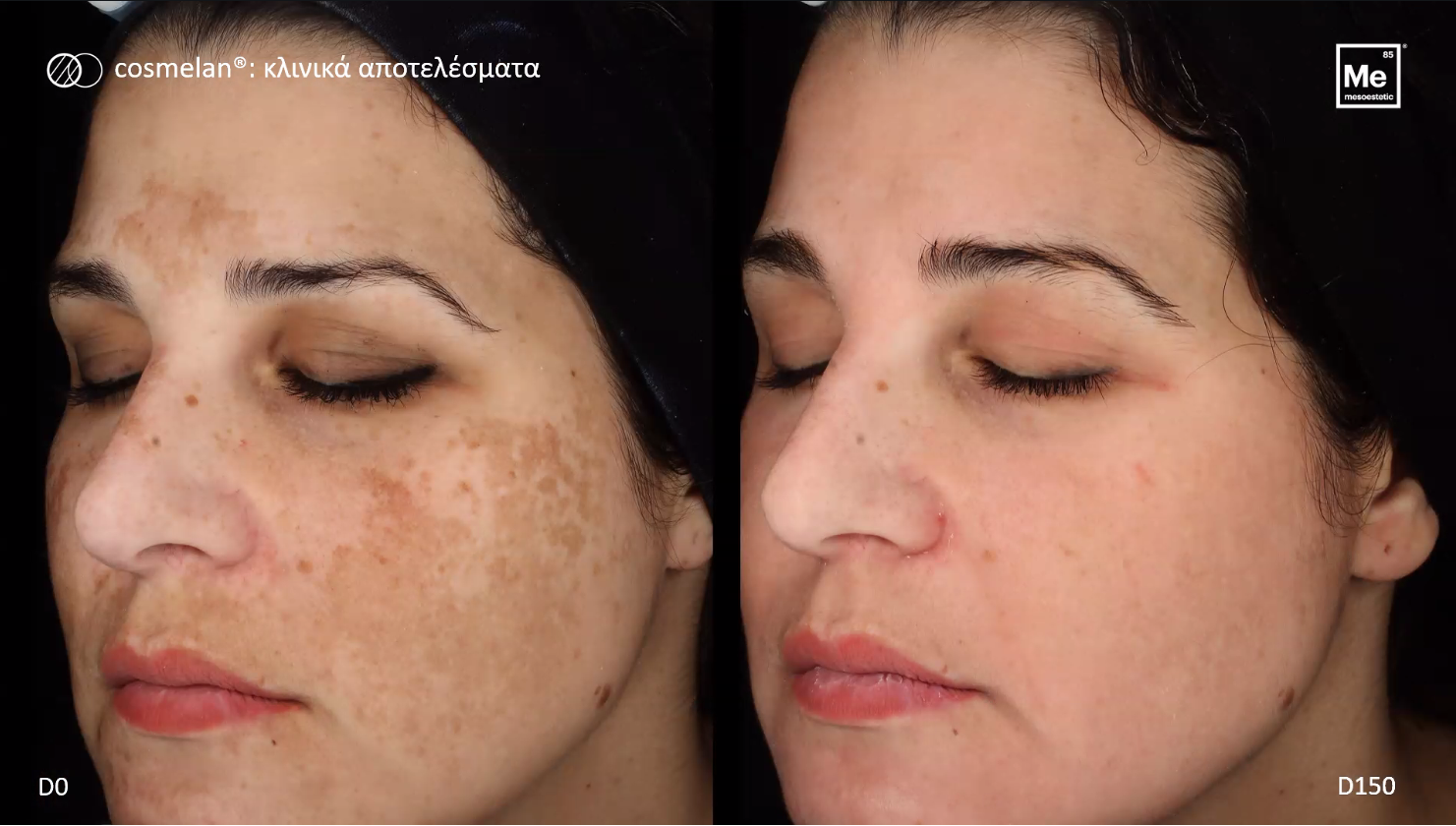 cosmelan before after
