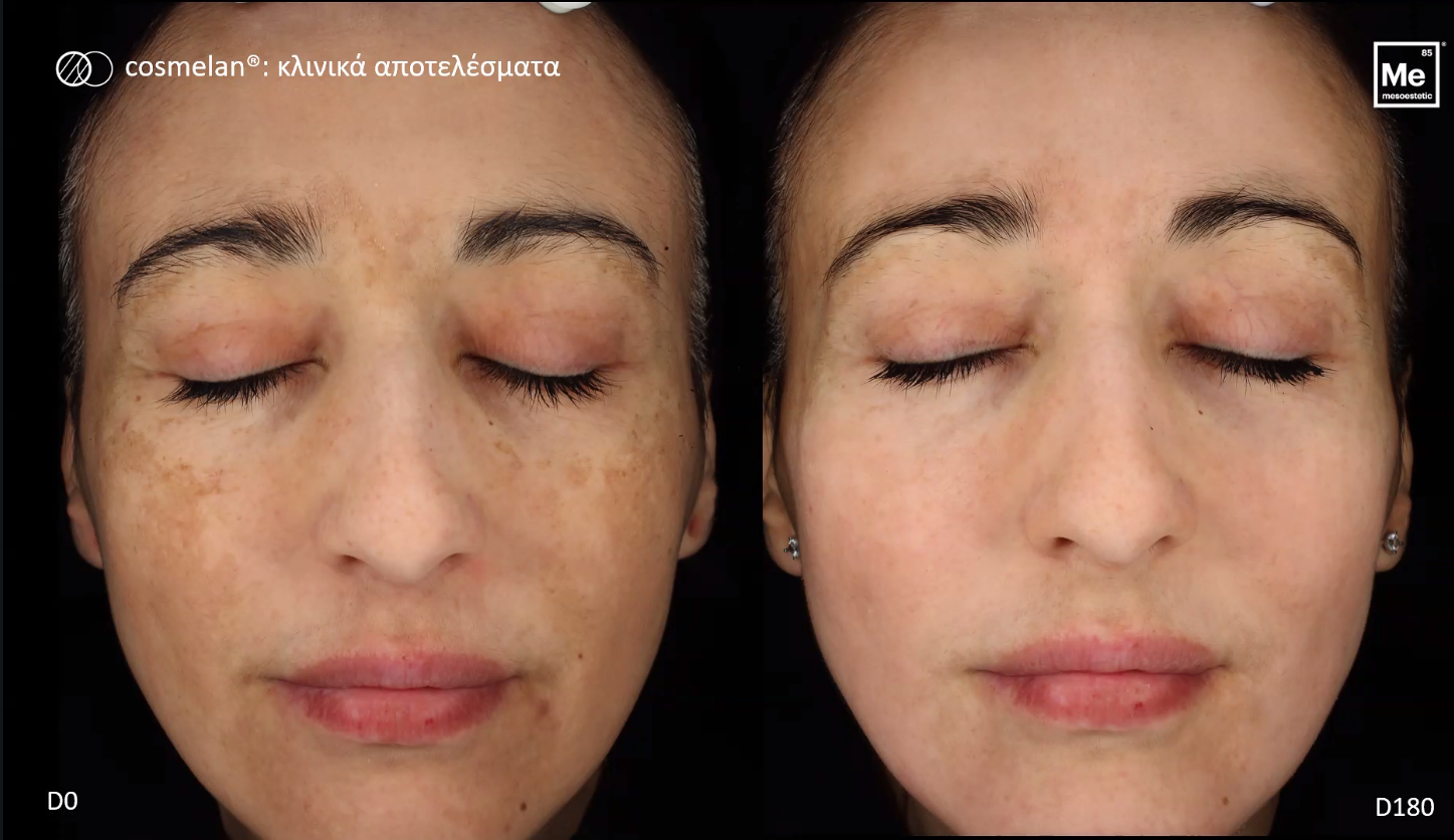 before after cosmelan